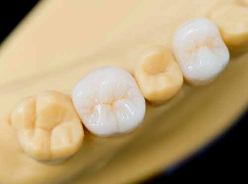 審美治療 ホワイトニング 二宮町 大磯町の歯科 歯医者 矯正なら鈴木歯科矯正歯科